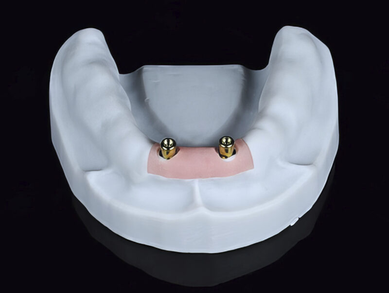 Arbeitsmodell mit axialen Abutments für supraimplantatgetragene herausnehmbare Prothese