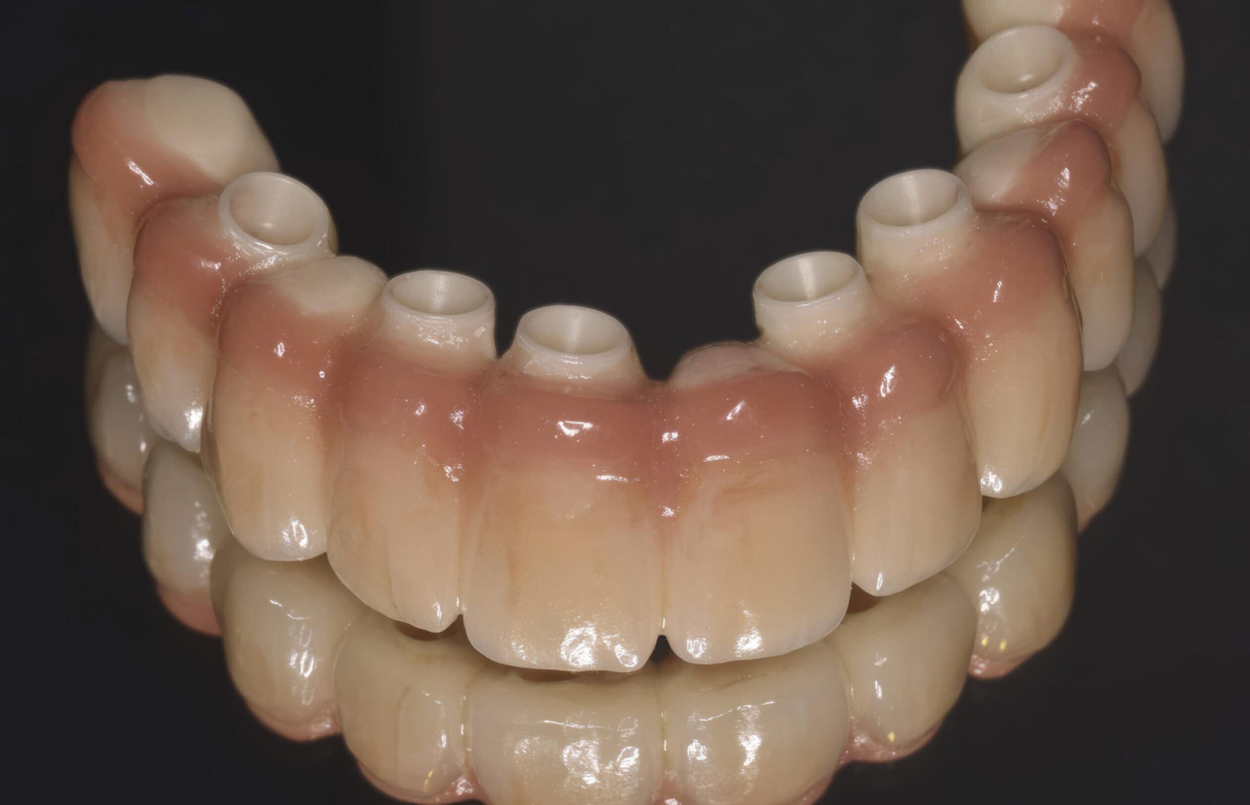 CAD:CAM-Implantatsteg aus Kunststoff mit künstlichem Zahnfleisch – Stabilisierte Prothese auf Implantaten