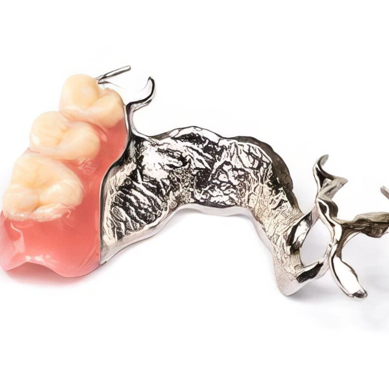 Herausnehmbare Stellite Metall-Kunststoff-Prothese 2