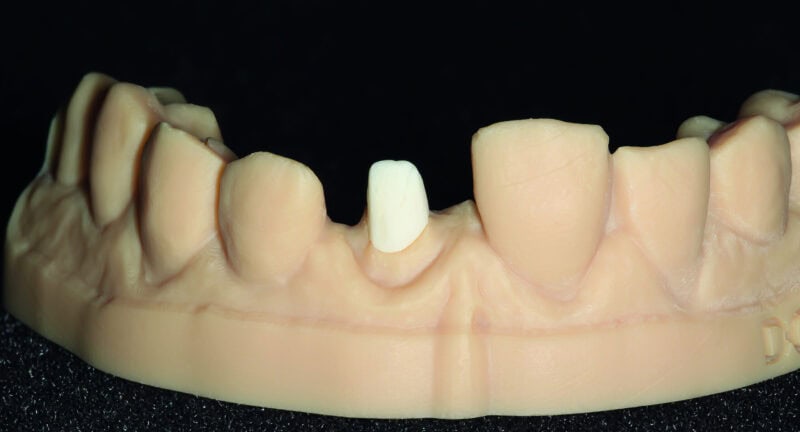 Inlay-Core aus Glasfaser – Innovative Lösung für eine widerstandsfähige, ästhetische und biokompatible Zahnrestauration 1