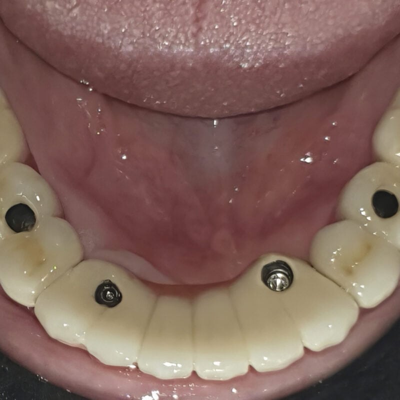 Komplett verschraubte Brücke auf Multi-Unit-Implantaten – okklusale Zugänge sichtbar für einfaches Schrauben:Lösen