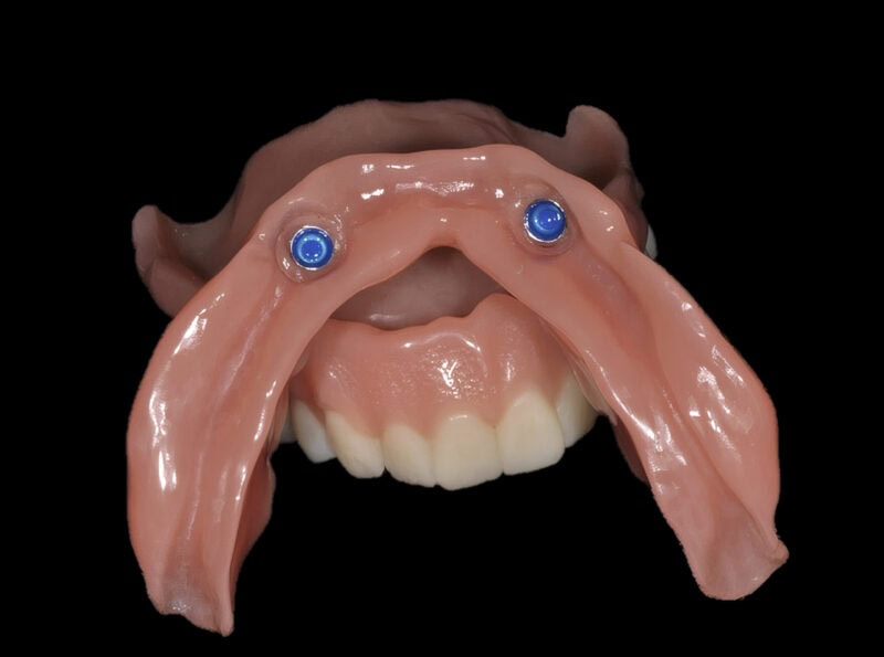 Supraimplantatgetragene herausnehmbare Prothese mit eingesetzten Locator-Attachments