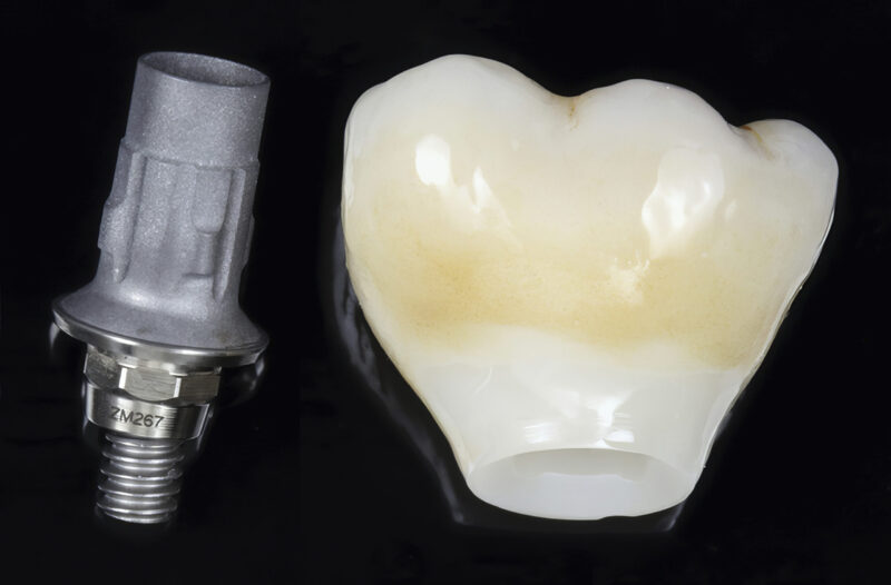 Ti-Base-Abutment und verschraubbare Krone – präzise Anpassung vor dem Zusammenbau und Einsetzen im Mund