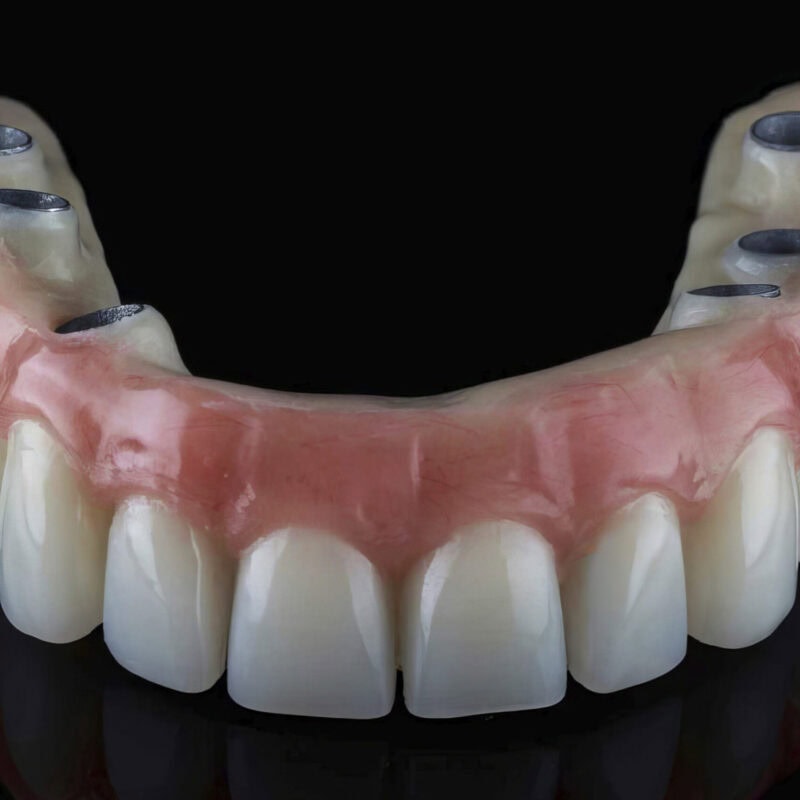 Vollständige All-On-Prothese mit Titanstruktur und ästhetischem Acrylaufbau
