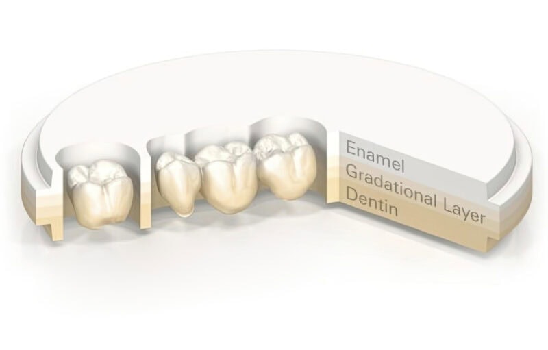 Vollzirkon-Multilayer-Krone – 100% Zirkon-Zahnprothese, transluzent und robust, für eine langlebige und ästhetische Restauration 1