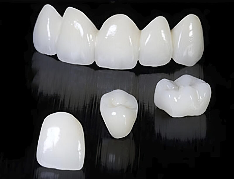 Vollzirkon-Multilayer-Krone – 100% Zirkon-Zahnprothese, transluzent und robust, für eine langlebige und ästhetische Restauration 2