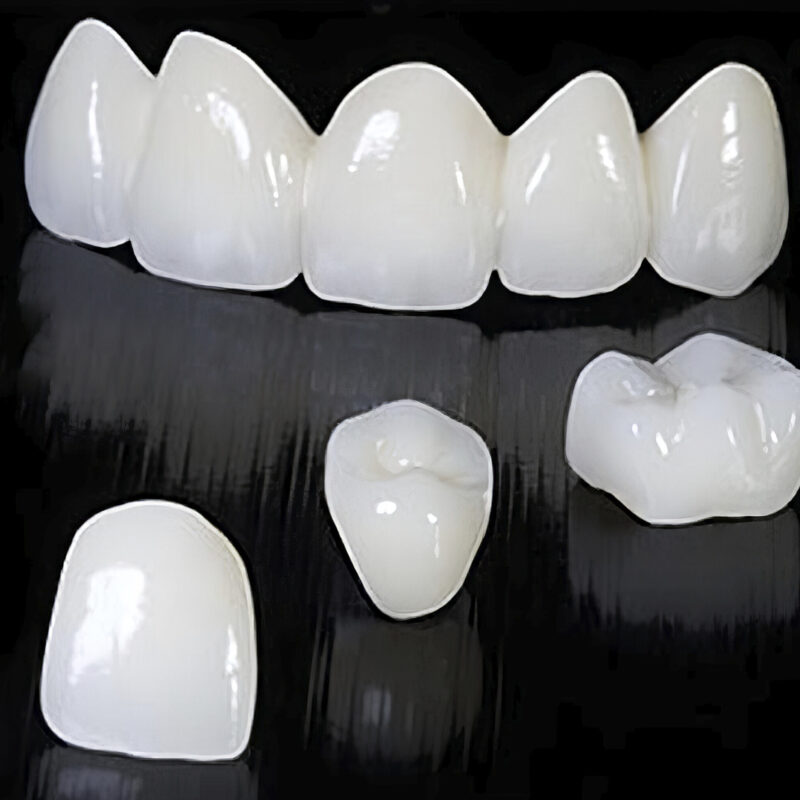 Vollzirkon-Multilayer-Krone – 100% Zirkon-Zahnprothese, transluzent und robust, für eine langlebige und ästhetische Restauration 2