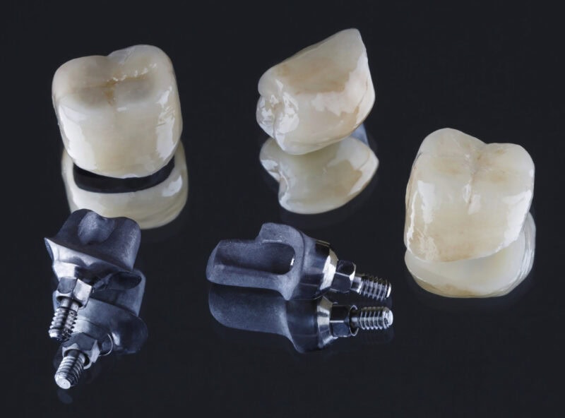 Zementierte Implantatkronen und individuelle Abutments – präzise Passung und natürliches Design