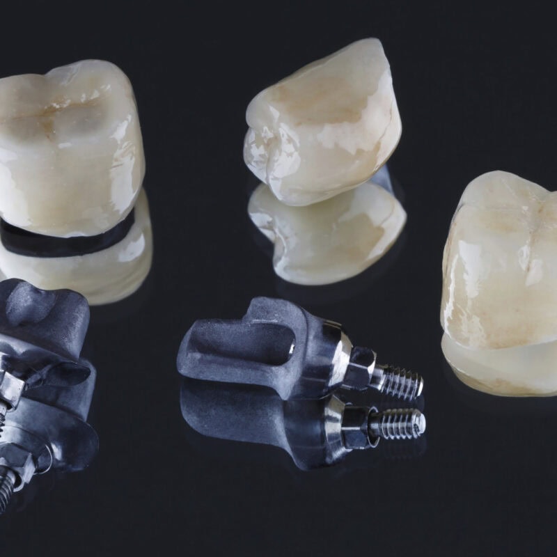 Zementierte Implantatkronen und individuelle Abutments – präzise Passung und natürliches Design