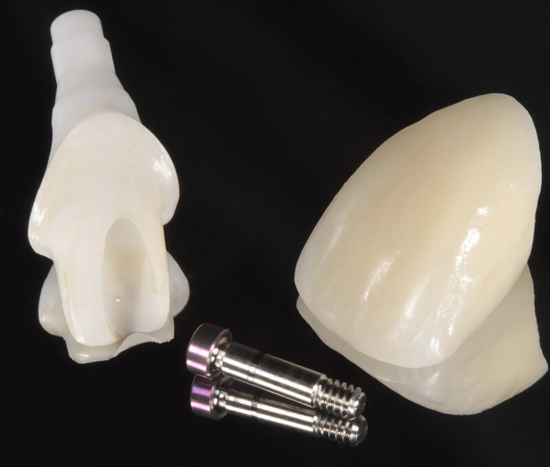 Zementierte Krone auf Implantat mit Titanabutment – ästhetische Einzelzahnversorgung